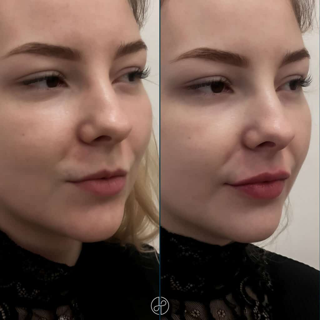 filler-lips-f-e-13-11-203