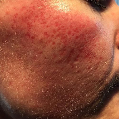 rosacea-foer-right
