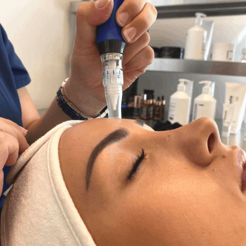 skinpen microneedling