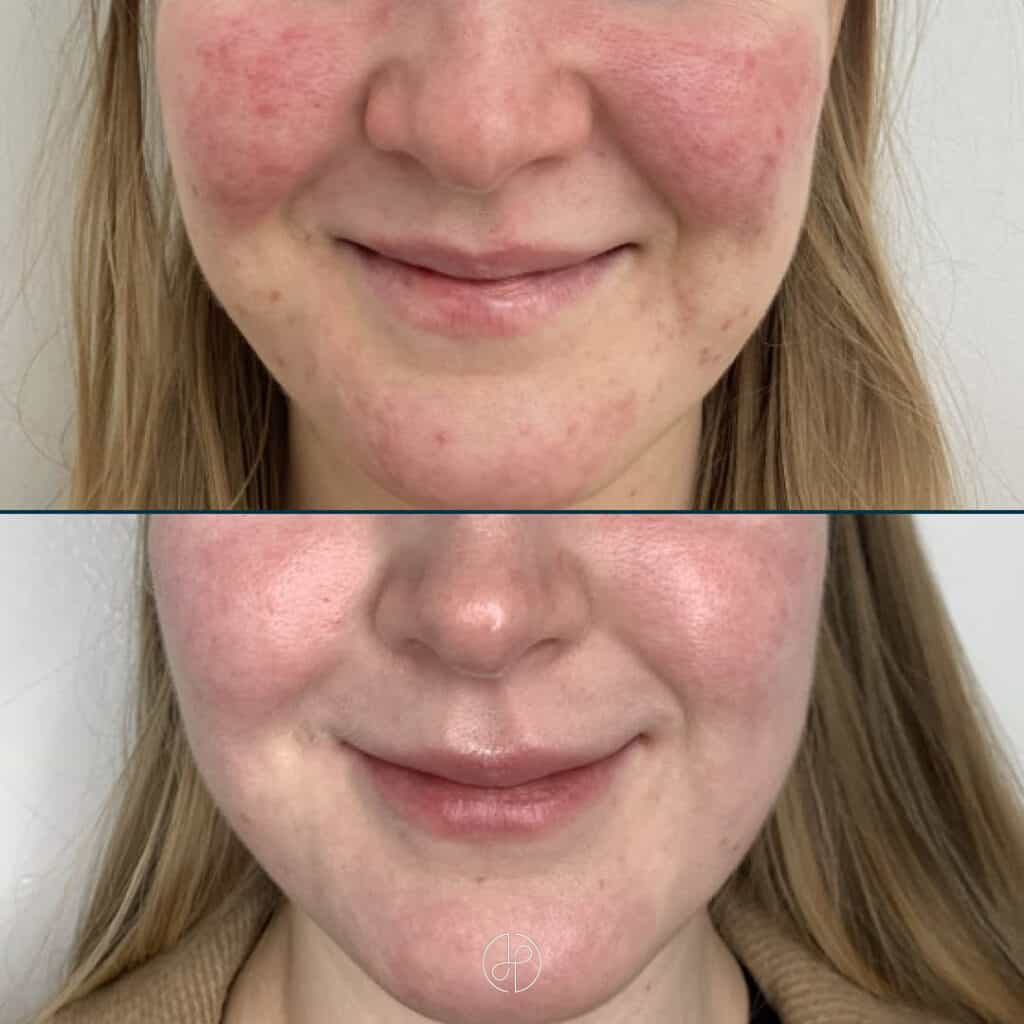 rosacea behandling laser