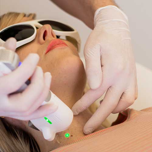 rejuvenation hudforyngende laser