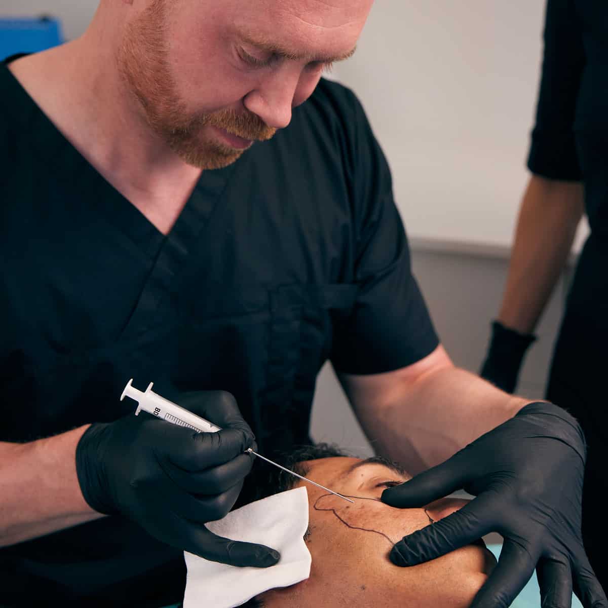 ACNE SCAR TREATMENT - SUBCISION AND FILLING