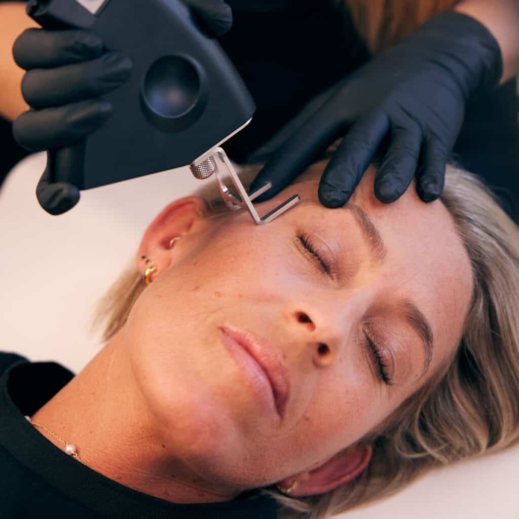 laser behandling af ar hos cutis clinic