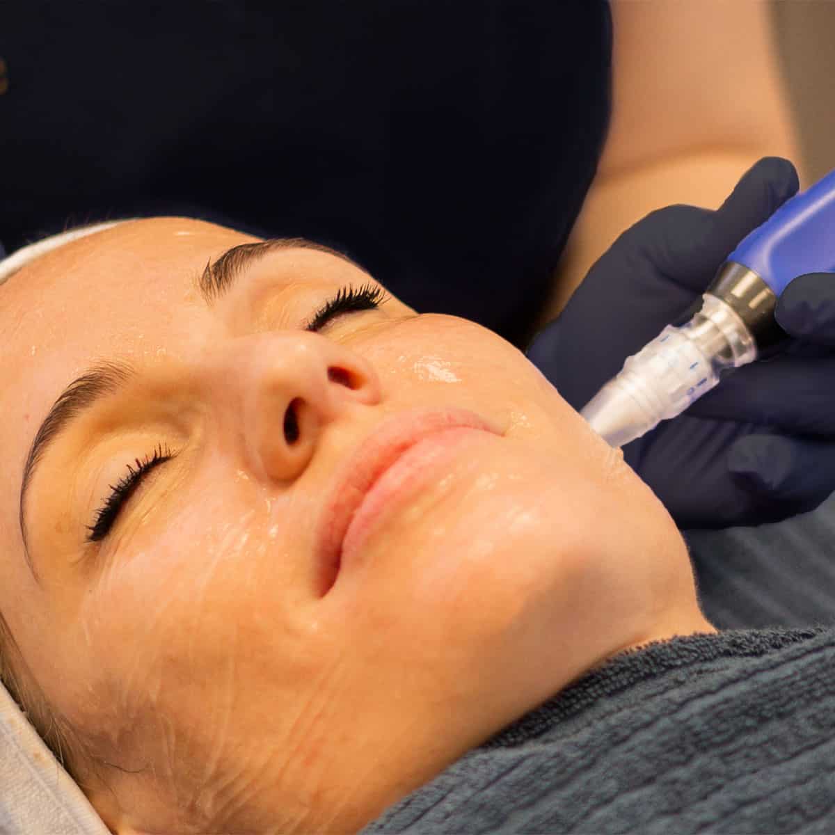 microneedling