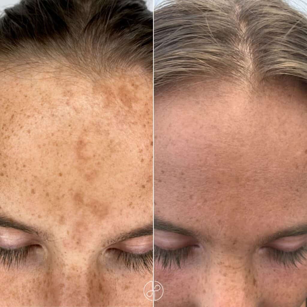 melasma før efter