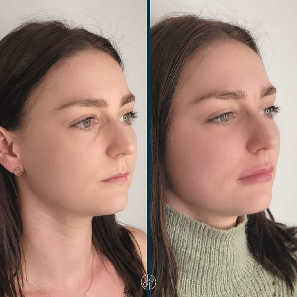 Behandling med filler før og efter