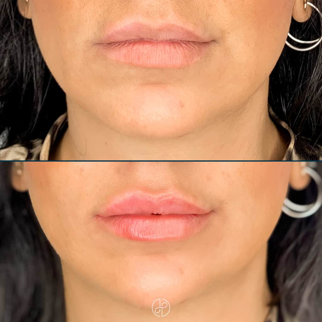Behandling med filler i læber før og efter
