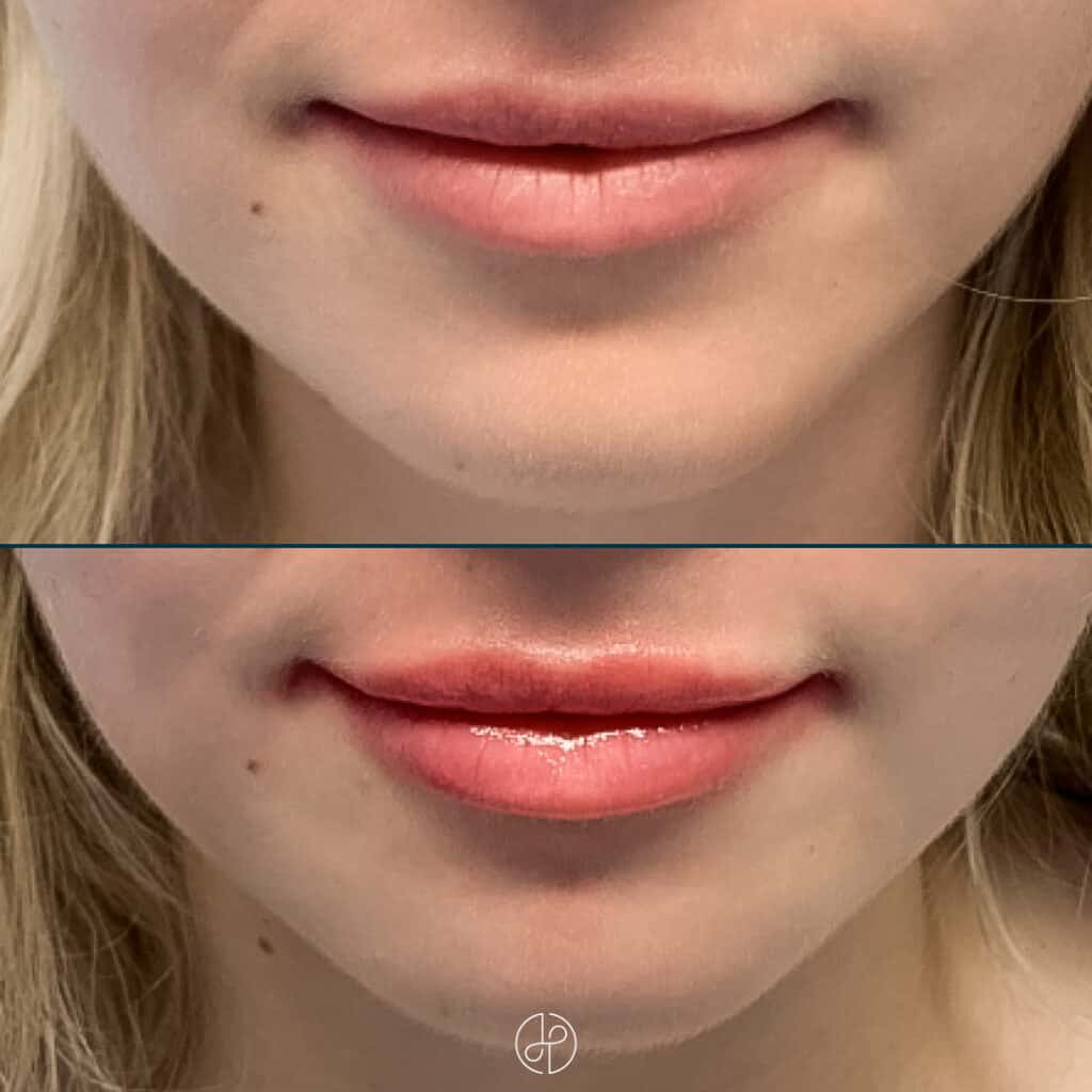 Behandling med filler i læber før og efter