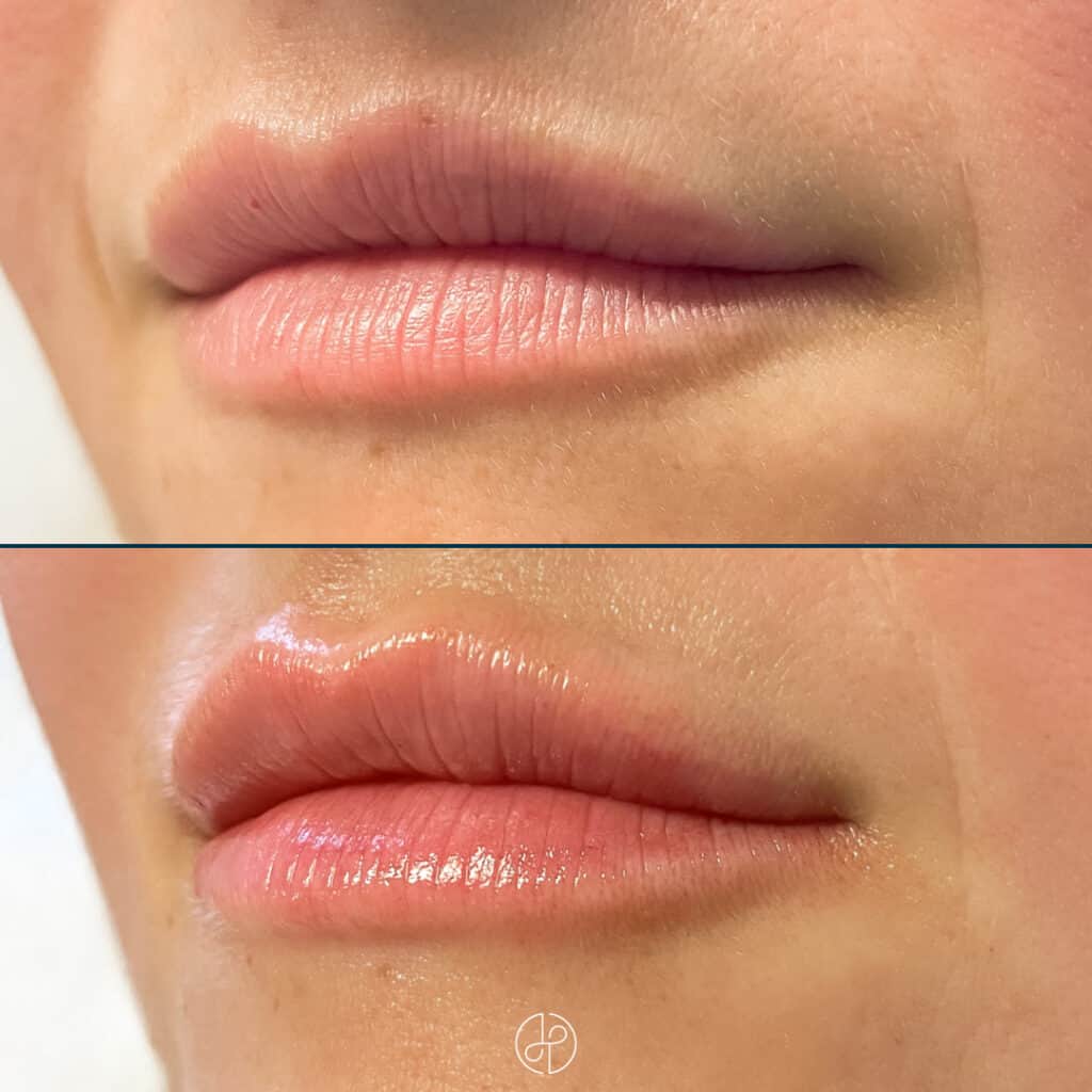 Behandling med filler i læber før og efter