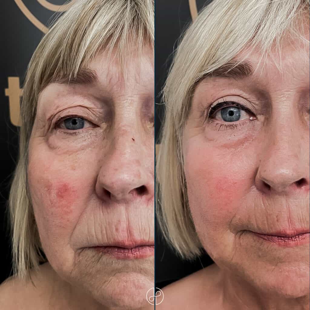 genius rf microneedling