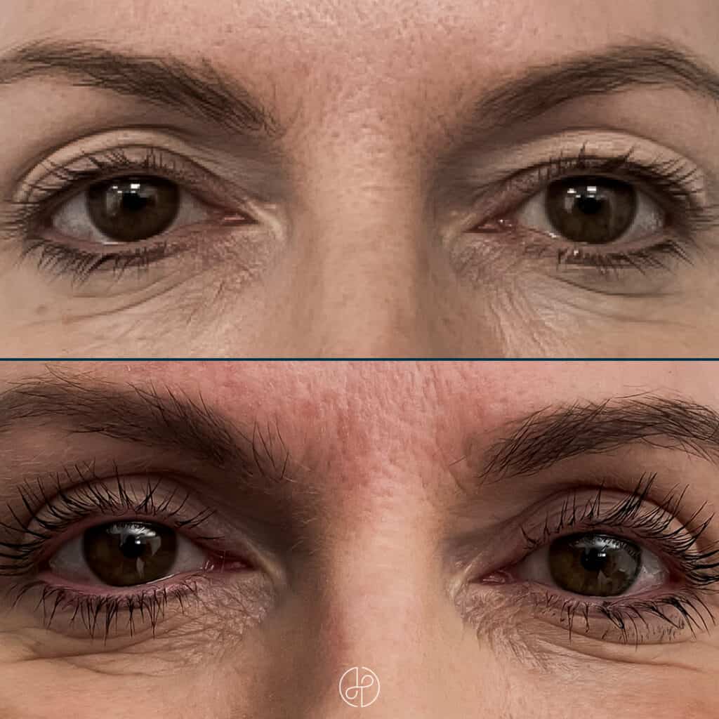 øjenlågsoperation før efter