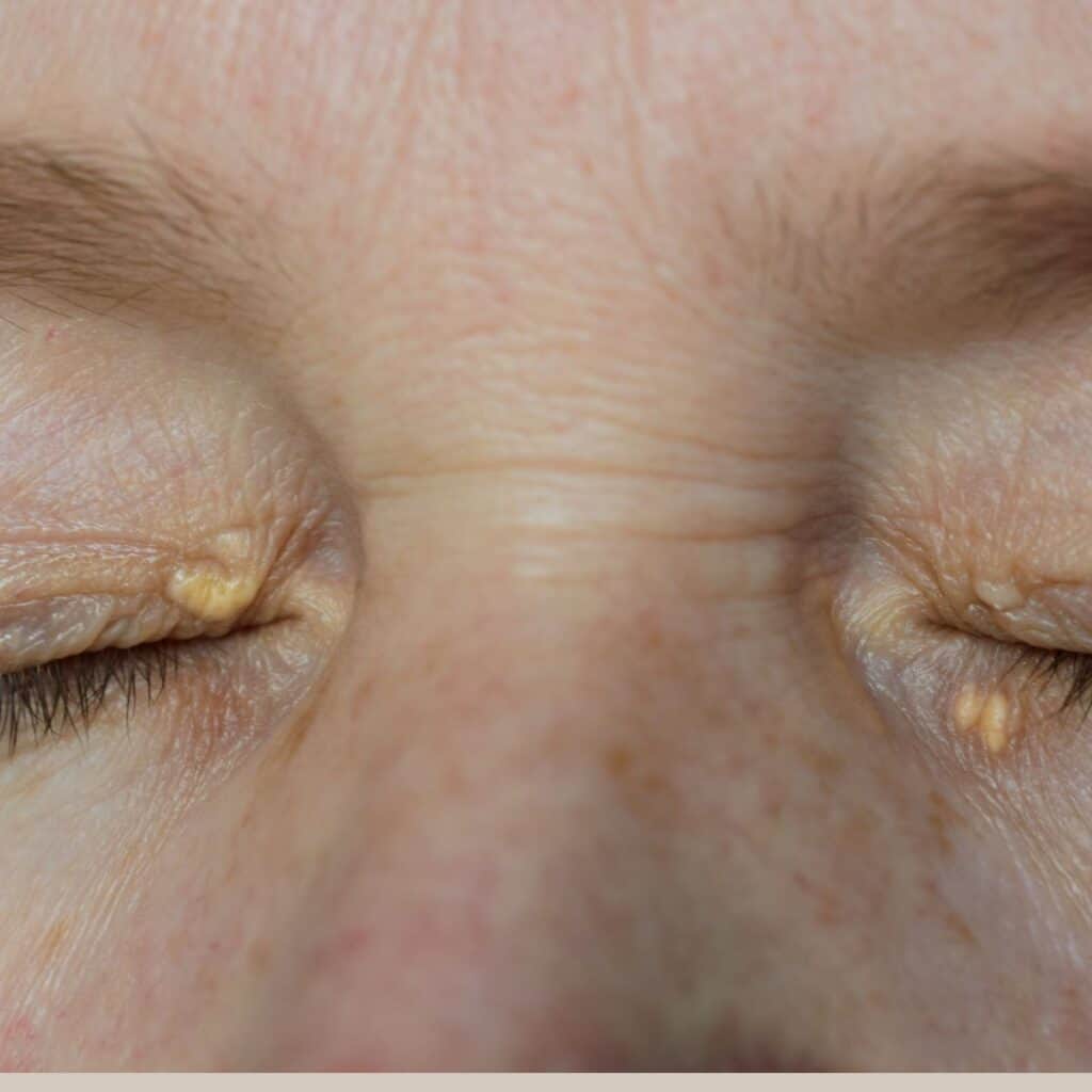 xanthelasma kolesterolpletter