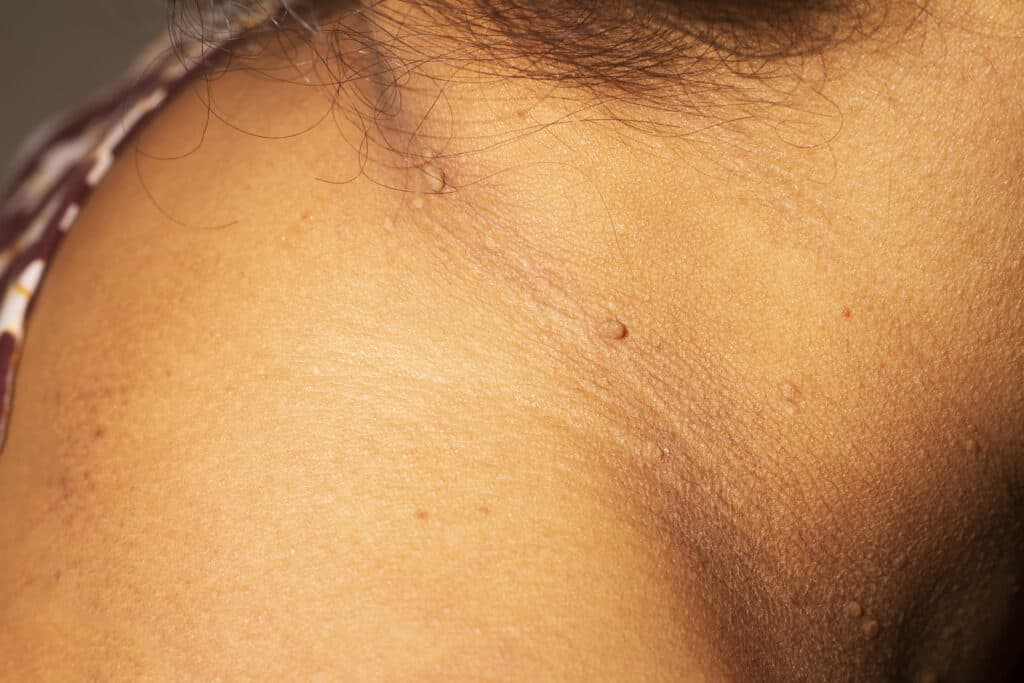 skin tags fjernelse af skin tags