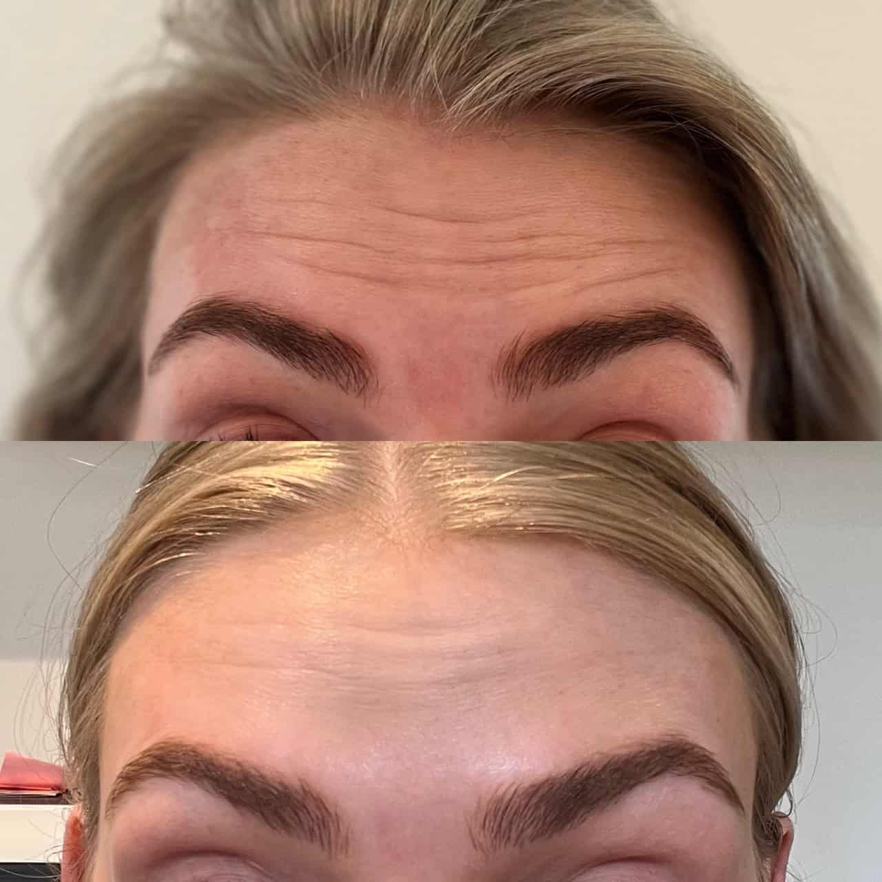 meso biotox
