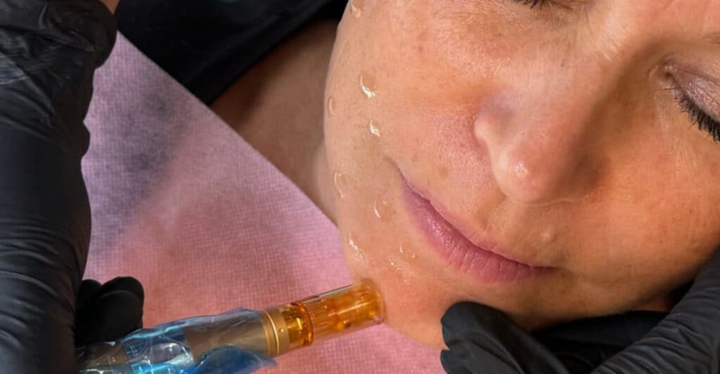 mesoterapi vitamin boost