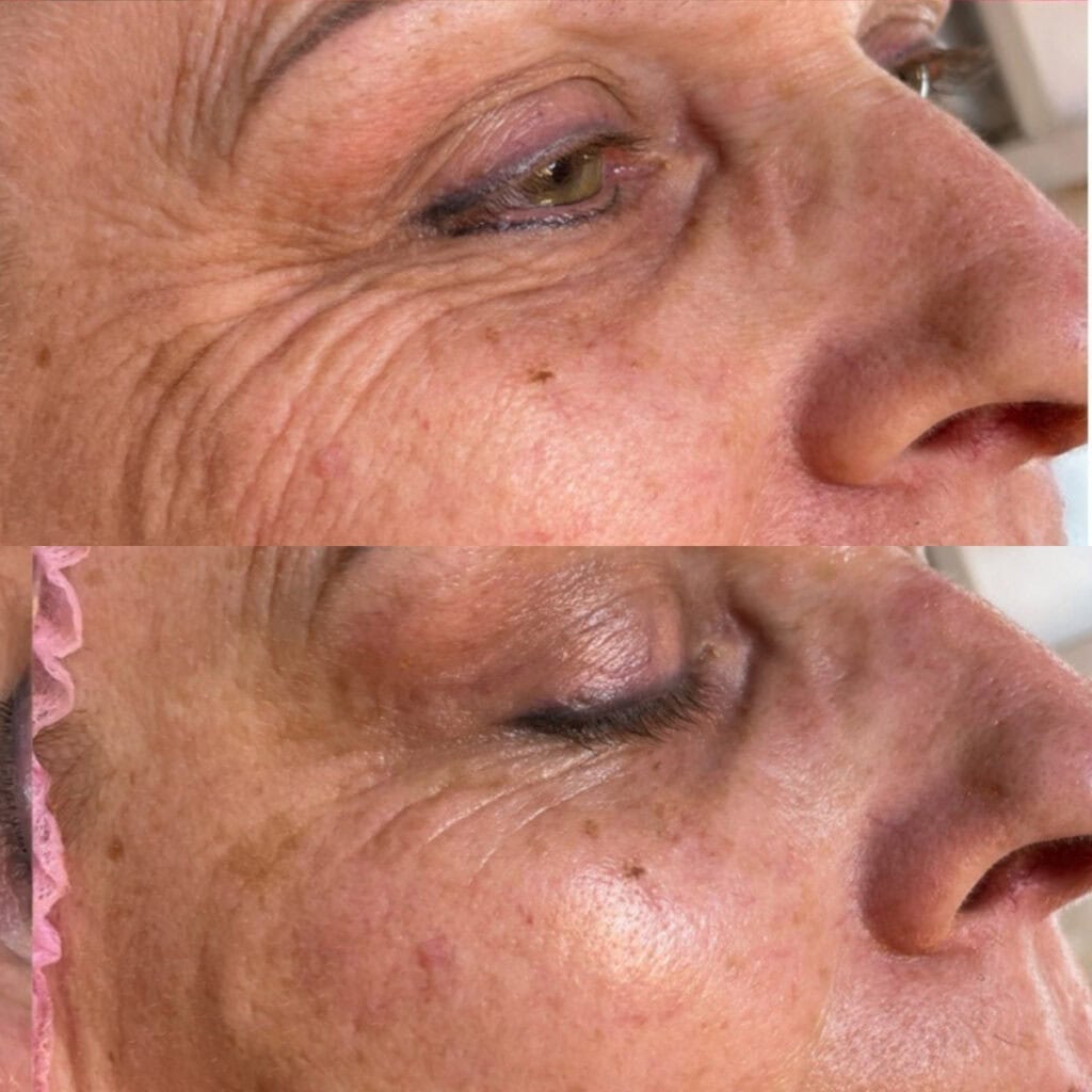 mesoterapi vitamin boost før efter