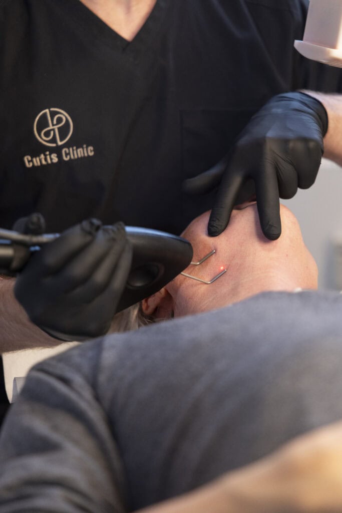 Laserbehandling med fraktioneret CO2 laser hos Cutis Clinic